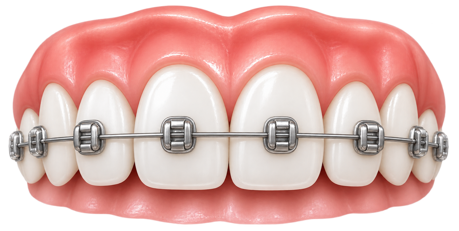 Orthodontic treatment teeth with metal braces and wire