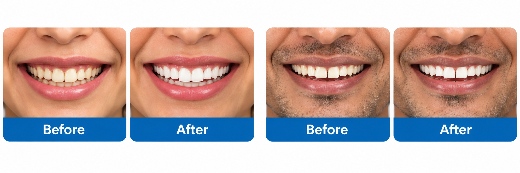 Before and After smile transformations for two dental patients